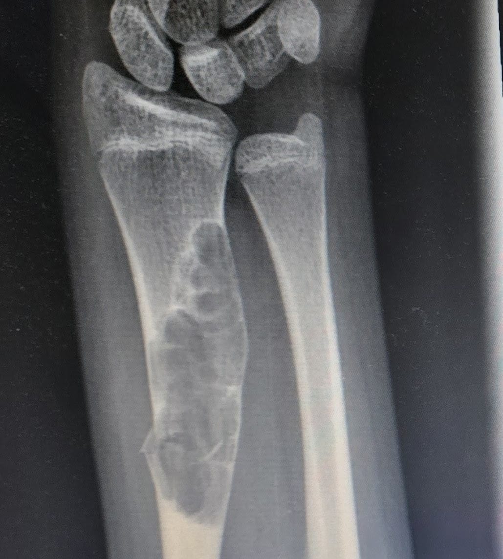 Radiografía de lesión ósea en radio distal — caso real tratado en CorpOs Consultorio Articular, Monterrey